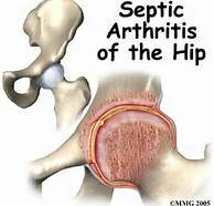 Infectious Septic Arthritis - Causes, Symptoms and Treatments